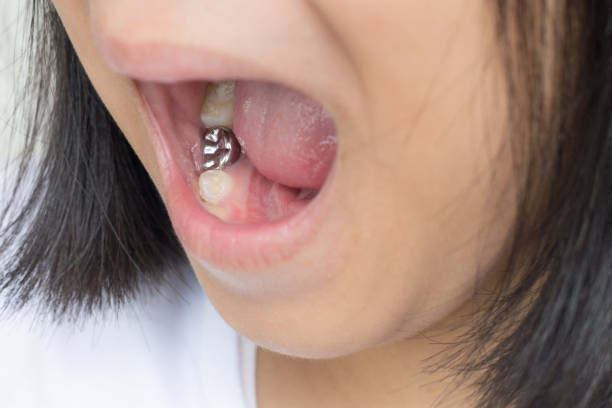 Pediatric dentist placing a stainless steel crown on a child's baby tooth