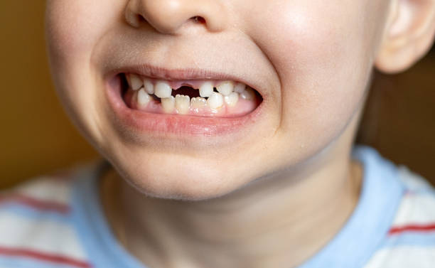Pediatric dentist examining a child's decayed baby tooth